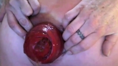 Biggest anal prolapse